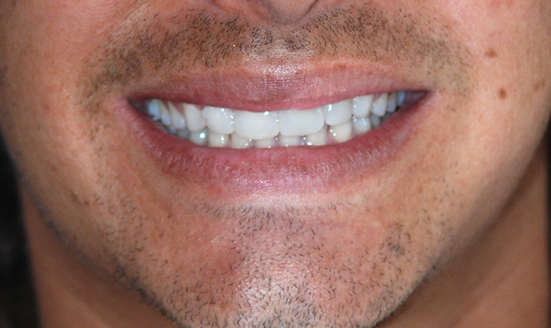 La facette dentaire – Docteur Albert Pinto